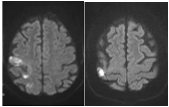 Figure 2: A symptomatic right ICA re-stenosis was assumed. The patient was submitted to right carotid angioplasty with stenting six days after admission. During her stay at the stroke unit, the patient began to improve from the dysfluency. Her pattern of speech started to be slightly more fluent, despite she has continued to prolong and repeat few sounds. Patient was discharged after nine days with high-intensity statin and double anti-platelet therapy during 30 days, and after this period with single anti- platelet lifelong.