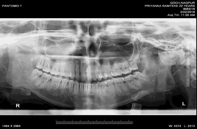 Figure 2: The pre operative OPG.