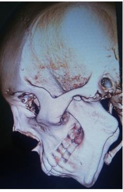 Figure 3: Preoperative CT scan images. The case was diagnosed as unilateral TMJ ankylosis. The surgical treatment of gap-arthoplasty with inter- positional grafting with abdominal fat pad and bilateral coronoidotomy was planned. The necessary blood investigations were done. The patient was taken under general anaesthesia with fibreoptic intubation maintained on hypotensive anaesthesia. The alkayat- bramley incision was taken for approaching the ankylosed mass in temromandibular region as seen. The skin & superficial fascia flap reflected to expose the pre auricular TMJ region. The oblique incision taken on the zygomatic arch and the subperiosteal dissection done to expose the ankylotic mass as seen in figure 4. A complete bony union of glenoid fossa in sphenoid bone and the superior part of ramus was seen. A condylar retractor was positioned and gap arthoplasty performed. Figure 5 shows the gap created of 1.5mm. The smooth surface on medial side was confirmed as remnant of head of the condyle displaced in previous fracture. The ipsilateral coronoidectomy was performed through same surgical approach. The contra lateral coronoidotomy was performed intraorally. The mouth opening achieved after this was 45mm as seen in figure 6.