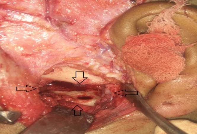 Figure 5: Gap created after removal ankyltic mass