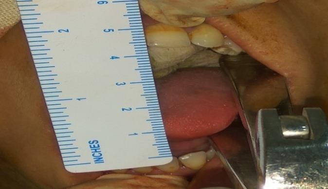 Figure 6: Mouth opening achieved on table. The interpositional graft was harvested from the abdominal region as seen in figure 7 through an elliptical incision. A dermal plus adipose tissue was harvested. It was transferred to the gap as free flap and inserted (Figure 8).