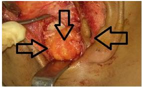 Figure 8: Interposition of derma fat in the gap.