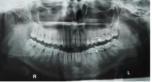 Figure 9: Postop OPG. This acts like interposition to prevent reankylosis. The layer wise closure with interrupted suturing and mini vac drain placement was done. The patient was extubated and post anaesthetic recovery was uneventful. The patient was kept on forceful mouth exercise under supervision with Heister’s mouth opener. Figure 9 shows the post operative OPG showing the gap in place of TMJ. She was guided to close with elastics. The mouth opening maintained was 29mm after one month. She is still under long term follow up.