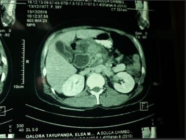 Figure 3: Choledochal cyst. Endoscopic retrograde cholangiopancreatography indicates dilation of the intra and extrahapathic biliary tree without evidence of gallstones in situ with gallbladder in situ (Todani IV-A) (Figure 4).