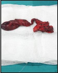 Figure 4: Dilatation of the biliary tree with gallbladder in situ alitiásic. In complementary laboratory tests there is no alteration in the leukocyte formula; however, there is a slight increase in bilirubins due to direct Bilirubin. Physical examination highlights an anicteric patient, painful abdominal level to deep palpation in the right hypochondrium. She underwent laparotomy finding a gallbladder, fibrous wall, cystic duct of 10 cm in length, with several bends, cystic tumor involving common hepatic duct, two distal thirds of the cystic duct and common bile duct to her retropancreatic portion of ducts diameter. cm. En bloc resection involving the gallbladder, cystic duct, common hepatic duct and common bile duct to the retropancreatic portion is performed (Figure 5); finally bilioenteric anastomosis in Roux-en-Y (Figure 6).