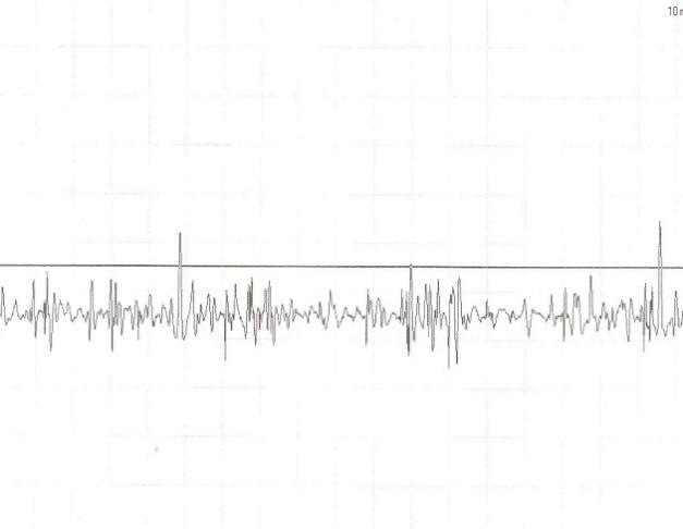 Figure 4: Pre treatment: ‘++’ Activity seen at rest.