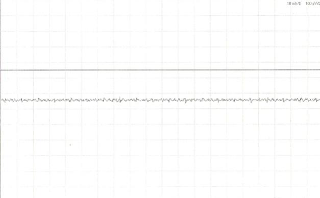 Figure 5: Post Treatment: Sparse activity seen at rest.