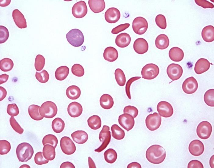 Figure 3: Peripheral smear from a case of sickle thalassemia showing presence of both sickle cells and target cells.