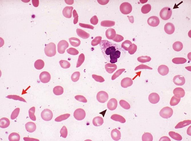 Figure 4: Peripheral smear from a case of sickle cell anaemia showing presence of sickle cells (red arrow). Occasional Howel-Jolly body is also seen (Black arrow).