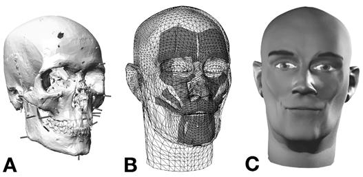 Figure 2: Facial reconstruction using computer software. (Image courtesy of KoljaKähler, MPI Informatik Saarbruecken, Germany. Several regional methods have recently been proposed, where the face and skull are segmented into regions, and the relationship of each region is then learned independently [28]. After which, the facial regions of a given skull are estimated and finally glued together to generate a face [29]. Have given a summary of the general workflow which has been found to be the same for all current computer- aided techniques [17]. They are basically dependent on the craniofacial model which contains the vital information about the faces and their relationship with the underlying skull and can be deemed to correspond to a person carrying out the manual reconstruction. The process is carried out by first examining the skull to obtain the biological characteristics and digitizing it through the different techniques available. The reconstruction is then performed by calculating the geometrical relationship between the unknown and the craniofacial model. Further details can be added to better represent the face of the individual. The current inclination in facial reconstruction is towards the computerization of the techniques. However, with the ever-changing and advancing technology, it is too soon to designate the best approach or make the comparison between methods. In such instances, the major step to take is to establish reliable standard databases of facial components [2]. However, while the computer technology is advancing at an astounding rate, one of the major problems remain the lack of tissue depth data upon which reconstructions are based on and also the fact that such data are seen as unreliable, and is still the subject of ongoing research. **Techniques for Tissue Depth Measurement** A number of studies have gone into quantifying the relationship between the soft facial tissues and the underlying skull, for the purpose of reconstruction. The first of its work, however, can be credited to Welcker, a German physiologist and anatomist in 1883, who documented the average tissue depth thickness of cadavers, by inserting a small surgical blade into various anthropometric landmarks on the face and then measuring the depth of penetration [8]. In the late 1880’s and early 1890’s, His and Kollman built upon Welcker’s work, slightly modifying it by inserting a thin sharp needle which had a small piece of rubber on its tip, instead of using a wider blade, resulting in a more accurate data [9-10]. Subsequently, the anthropologist Kollman along with the sculptor Buchly used a needle that was covered in soot and considered the clean part of the needle to be the tissue depth [6]. However, with the advancement in technology, tissue depth measurements began to be taken using radiographs, MRI images and CT scanners, but more recent measurements were taken using ultrasound, as it had the advantage of measurements being taken in an upright position [30]. But it also came with the difficulty of measuring due to the imperceptibility of the bone underlying the tissue [31]. All computerized reconstruction techniques up to this day use CT scanners for obtaining the virtual copy of the unknown skull. In case of live subjects for the database, CT scanner allowed both the skull and the face surface information to be obtained simultaneously and in the correct spatial relationship to each other. Some major disadvantages of this technique include health hazards caused by the radiation, being taken in a supine position and also its sensitivity to high-density material [30]. A non-harmful alternative to CT scanners were MRI images, although it had the same problem of being scanned in a horizontal position. Later on, Cone-beam CT (CBCT) scanners were developed and being used in medical practice. In contrast to conventional CT, CBCT scanners acquired images of subjects in an upright position. Moreover, CBCT images could be obtained with a lower absorbed dose at the cost of a slightly reduced image quality [32,33]. Hwang, et al. tested the reproducibility of CBCT scanners by measuring the soft tissue thickness at 31 landmarks on 20 subjects [34]. They then found that thickness was measured with high reproducibility, while also suggesting that certain landmarks should be redefined. During the twentieth century, various anatomists studied and collected the measurements of tissue depths in different racial and ethnic groups. Birkner (1904) studied Chinese cadavers; Fischer (1903) studied Papuan cadavers; Von Eggeling (1909) studied Herero (Namibian) cadavers; Suzuki (1948) studied Japanese cadavers; Rhine and Campbell (1980) studied American Black cadavers; Rhine, et al. (1982) studied American White cadavers; and Rhine (1983) studied Southwestern Indian cadavers [35].