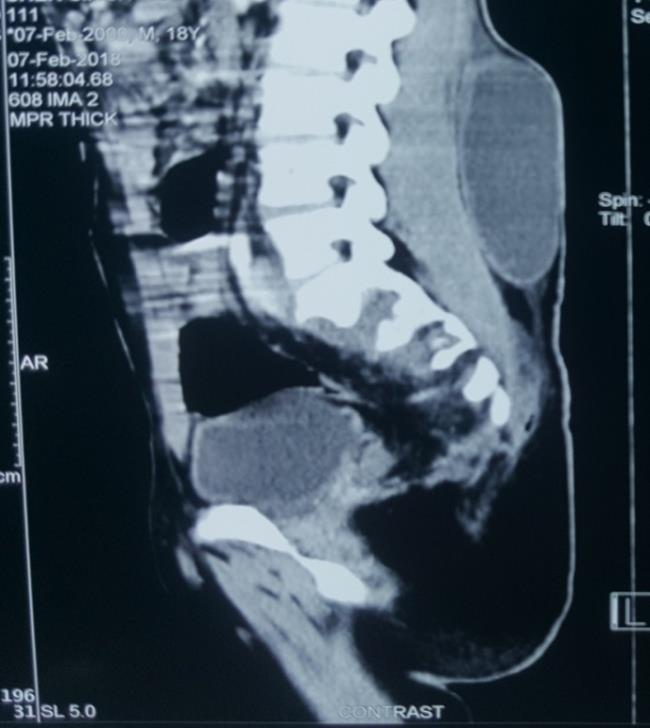 Figure 1: Lateral view on CT Spine: Pre- sacral collection causing significant erosion of underlying sacrum. Another large collection seen extending into the lumbar region.