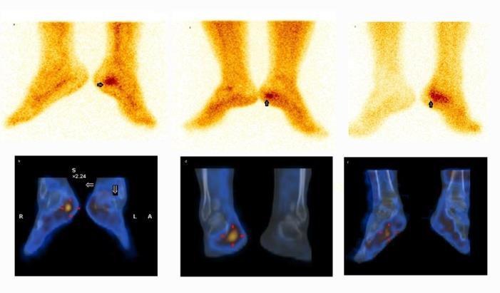 Figure 1: Focal (a,b), proximal 1/3rd (c,d) and diffuse (e,f) tracer uptake patterns on planar and SPECT/CT bone scintigraphy in the blood pool phase. Patients received a mixture of 1 ml of methylpredinosolone (20-40 mg) in combination with 1 ml of lignocaine-hydrochloride (0.1%) injected at the inflammatory site localized by scintigraphy. Treatment outcome was examined in terms of lessening of heel pain measured with a 100-point visual analogue scale (VAS) pain score, before and at 6 weeks after treatment. The treatment outcome was assessed as excellent or poor. Patients with improvement of VAS score equal or higher than 50% were graded excellent (treatment success) and those with scores of 0% - 50% poor (treatment failure). Improvement of 100% was considered “complete response” and 0% as “no response”.