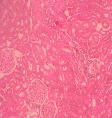 Figure 6: Server congestion coagulative necrosis of renal tubules in rats treated with 17 mg/kg lithium