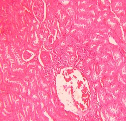 Figure 7: Sever congestion, tubular necrosis, scanty infiltration of inflammatory cells in rats treated with 34mg/kg lithium carbonate (H&E X100).
