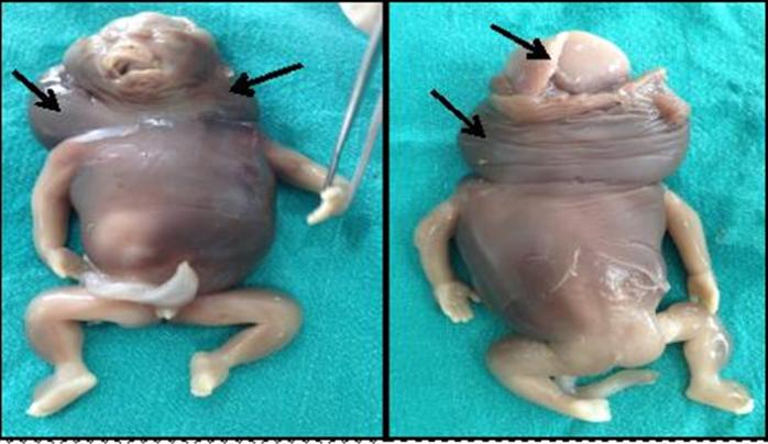 Figure 1: Male Fetus: 16-18 wks Hydrops fetalis Cystic hygromatus changes around the neck with & over riding of skull bones.
