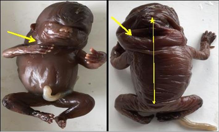 Figure 3: Female Fetus 2-16-18 Weeks: Macerated Hydrops fetalis with cystic hygromarous changes around the neck & skin on the back is wrinkled.