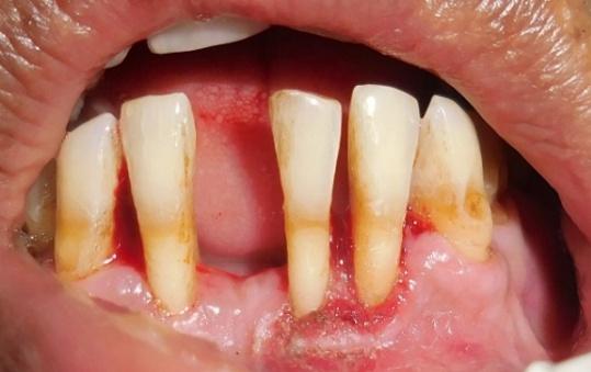 Figure 4: Immediate Post – Operative. The excised tissue was placed in 10% formalin solution and sent for histopathologic examination. Patient was given post-surgical instructions and prescribed antibiotics, analgesics for 5 days and recalled after 10 days.