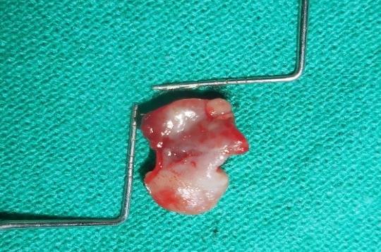 Figure 5: Excised Tissue.