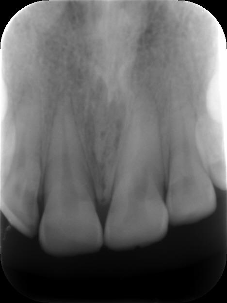 Figure 1: Abraded edges of two maxillary central incisors.