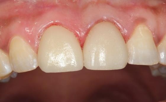 Figure 10: a) Final cementation buccal view. b) Final cementation buccal view. **Discussion** Esthetic treatment of discoloured anterior teeth presents a challenge in clinical practice. Minimally The veneer was covered with a glycerin gel as an oxygen barrier to ensure better polymerization of the resin cement. A thin layer of photo-cure resin cement (Variolink Veneer, Ivoclar Vivadent) was applied at the intaglio surfaces. The veneers were placed on the prepared teeth and pressed slightly with the fingers .light polymerization was carried out on both surfaces for 40seconds. Excess cement were removed and interproximal cement was removed with a micro brush and dental floss. The marginal area were polished by abrasive disc (Figures 8-10).