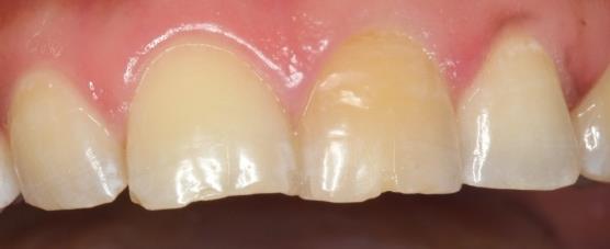 Figure 4: Diagnostic waxup.