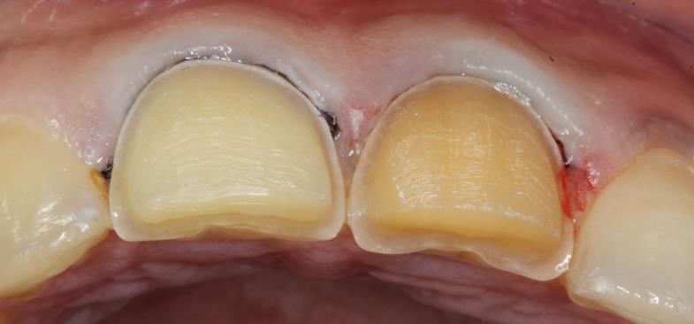 Figure 5: Labial preparation with finish line subgingival. The preparation of the incisal edge, was performed about 2 mm reduction. The preparation was extended to the lingual surface to give wrapped-around preparation geometry to cover the abraded incisal edge with restoration (Figure 6). The desired esthetic change was carried out in tooth form and in color and it was necessary to overlap the incisal edge, because there was sufficient buccolingual width.
