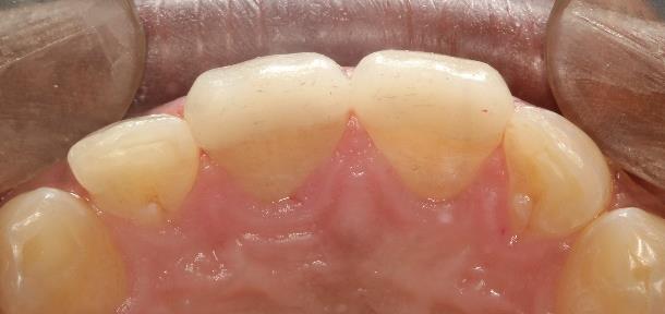 Figure 9: Final cementation lingual view.