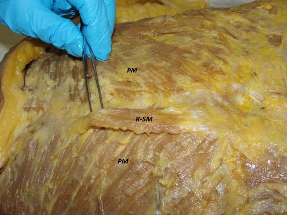 Figure 1: Photograph of the anterior thoracic wall showing a right sternalis muscle lying parallel to the lateral border of the sternum on the right side; left side not found. RSM: Right Sternalis Muscle. PM: Pectoralis Major.