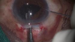 Figure 2: Postoperative photo with site of Enclavation. On the first postoperative day, the patient was examined specifically to assess the IOL centration, endothelial cell loss with the help of specular microscopy and macular oedema with the help of optical coherence tomogram (OCT). These were repeated at every follow up visit. A standard postoperative treatment of topical antibiotics (moxifloxacin 0.5% eye drops and tobramycin 0.3% eye drops ) given for 4 weeks and tapering doses of topical steroids (prednisolone acetate 1%) given for 4 weeks was followed.