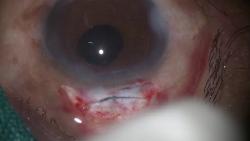 Figure 5: Preop vs Postop 3 month BCVA ≥ 6/12