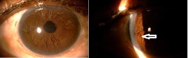 Figure 6: Endothelial cell count (cells/mm2) It is clear from the Table 3 that maximum endothelial cell loss occurs in the first week postoperatively which indicates more towards the intraoperative endothelial cell loss and not due to the Iris claw lens.