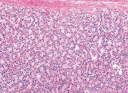 Figure 1: Follicular Adenoma (microscopically production of gland acini in various size and number is the characteristic feature).