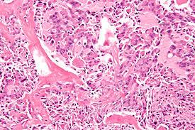 Figure 2: Papillary carcinoma thyroid (microscopically shows branching tree like pattern sharply outlined by papilliform axial fibrovascular stroma).