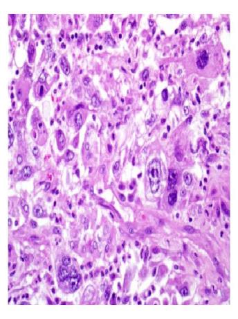 Figure 3: Anaplastic carcinoma (smear shows bizarre large malignant cells with macrophage like appearance).