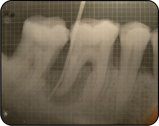 Figure 1: Pre Operative picture.