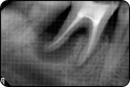 Figure 2: Pre Operative radiograph.