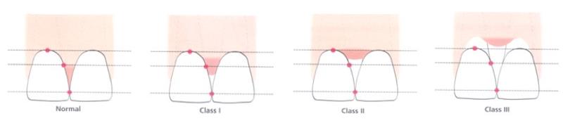 Figure 1: Types of Embrasures.
