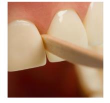 Figure 2: Woodstick as an Interdental Aid.