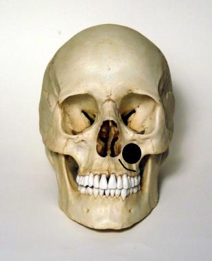 Figure 3: Bone removed during Endoscopic Denker’s approach. Bone may be removed from the lateral wall of the pyriform aperture to the infraorbital nerve.