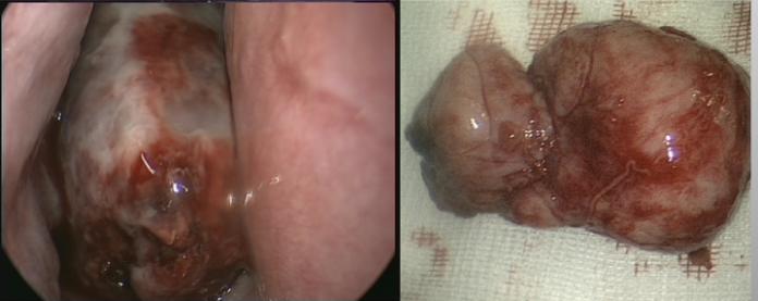 Figure 4: Incision site for the Caldwell Luc approach. Bone is removed from the anterior wall of the maxillary sinus, inferior to the infraorbital nerve and superior to the dental roots.