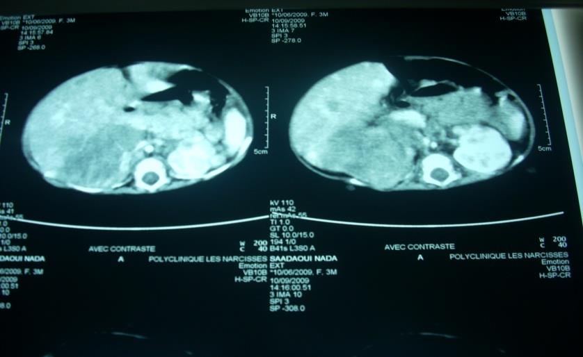 Figure 2: Abdominal CT scan. The patient underwent a resection of the right adrenal mass, and biopsy of left adrenal mass and liver. The result with pathologic immune histochemical study concluded for a right adrenal neuroblastoma poorly differentiated and invasive high-grade malignancy with liver and controlateral location. Research NMYC amplification has not been available nor any other markers of the tumor.