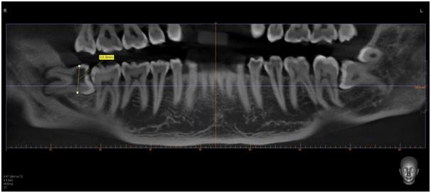 Figure 1: Depth of Impaction: Distance from point of application to white line (Occlusal plane).