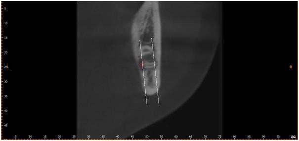 Figure 2: Position of inferior alveolar canal: Either lingually positioned, apically positioned or bucally positioned.