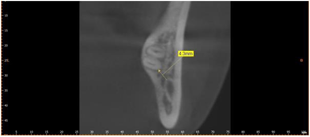 Figure 3: Distance from root apex to the wall of the canal.