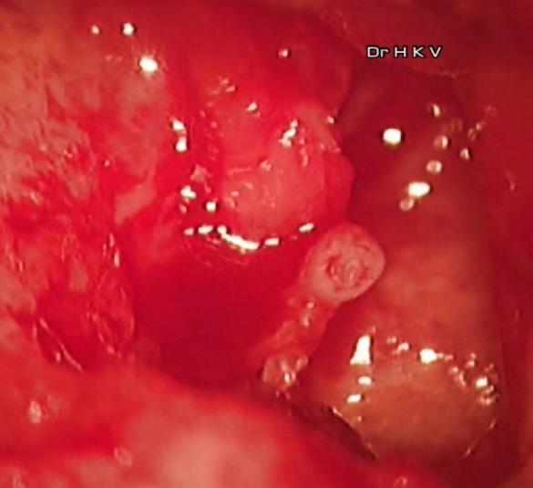 Figure 3: Postoperatively, the facial nerve weakness resolved completely.