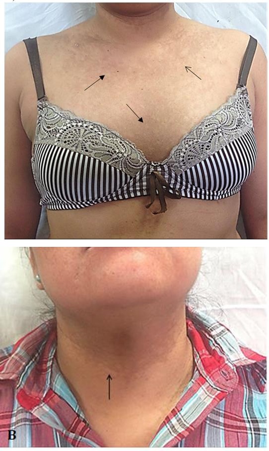 Figure 1: A) Hyperpigmented and desquamative skin lesions with predominance in the anterior thorax. Intermammary area B) Dermatosis located in the anterior part of the neck. C) Schematic of the previous topography.