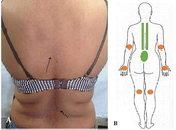 Figure 2: A) Dermatosis in the posterior thorax, located in the internal scapular line and paravertebral, as well as at the lumbar level. B) Schematic of the posterior topography.
