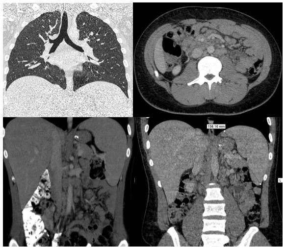 Figure 1: CT findings in a case of extrapulmonary pneumocystosis.