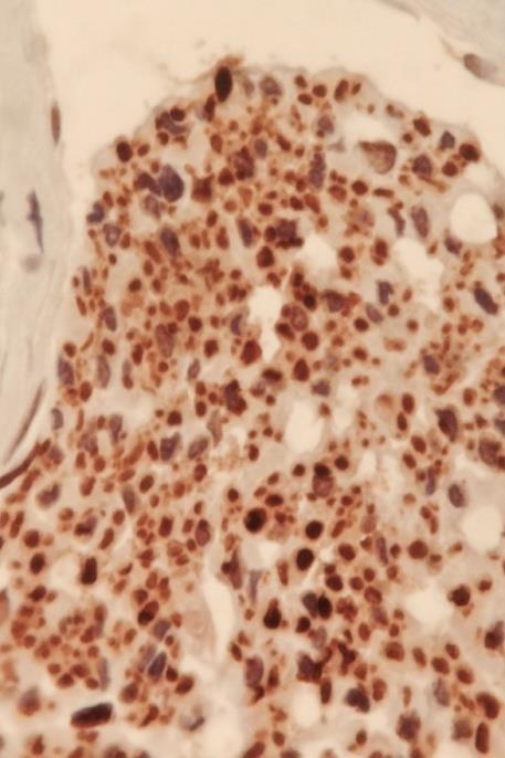 Figure 3: Immunohistochemical staining for neurofilaments. Figure 3 shows the immunophenotype obtained by flow cytometry evaluation of classical markers of MSCs as follows: CD105+, CD34-, CD73+, CD90+, and CD45-. In Figure 4, the osteogenic differentiation of MSCs after 20 days in culture is shown as part of the evaluation of the differentiation capacity of the obtained MSCs.