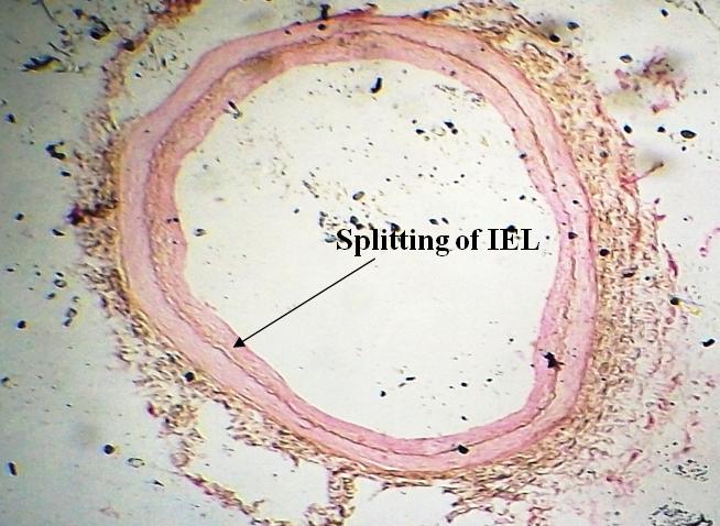 Figure 5: Showing Grade-III Degeneration of Internal Elastic Lamina (IEL).